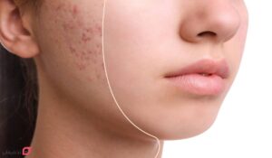 سابسیژن چیست | چگونه جای جوش را نابود میکند | ماندگاری + عکس
