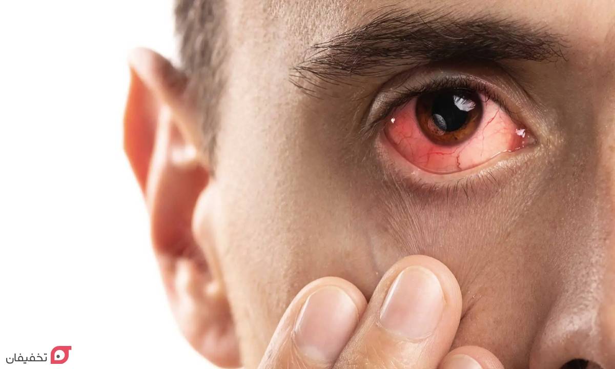 علت قرمزی چشم در بزرگسالان