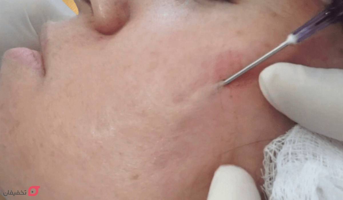 سابسیژن چگونه انجام می شود؟