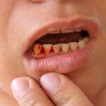 علت خونریزی لثه در خواب، اول صبح و هنگام مسواک زدن 💙 درمان 30 علت خونریزی لثه