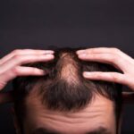 جدیدترین روش کاشت مو بدون بانک مو چگونه امکان پذیر است؟ 50 جدیدترین روش کاشت مو بدون بانک مو