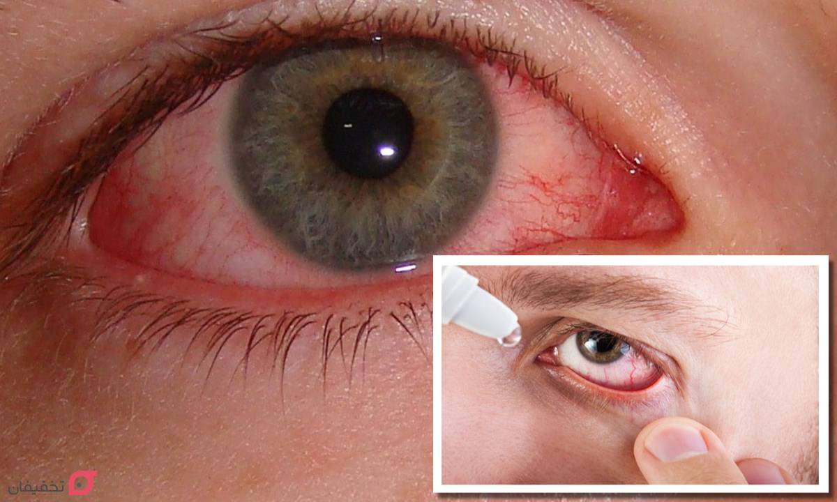 بهترین قطره برای قرمزی چشم