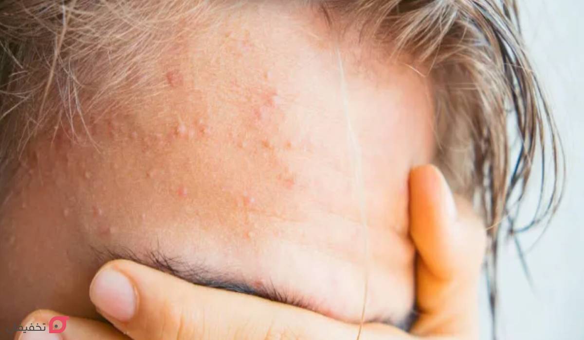 علت جوش پیشانی