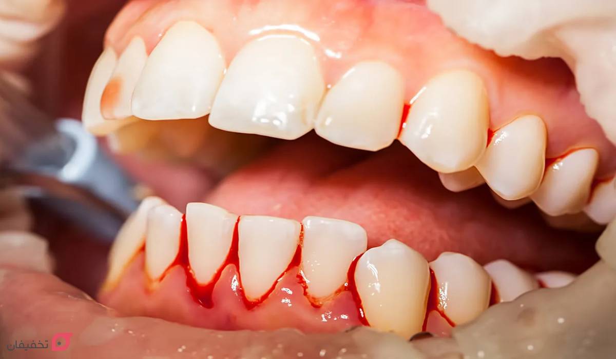 علت خونریزی لثه چیست؟