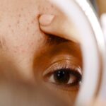 جوش پیشانی نشانه چیست | 8 علت اصلی و 6 درمان سریع در خانه 20 جوش پیشانی نشانه چیست