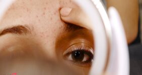 جوش پیشانی نشانه چیست | 8 علت اصلی و 6 درمان سریع در خانه 18 جوش پیشانی نشانه چیست