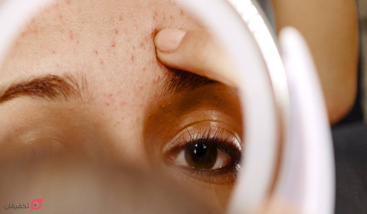 جوش پیشانی نشانه چیست