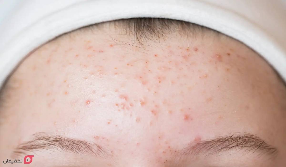 جوش پیشانی نشانه چیست؟
