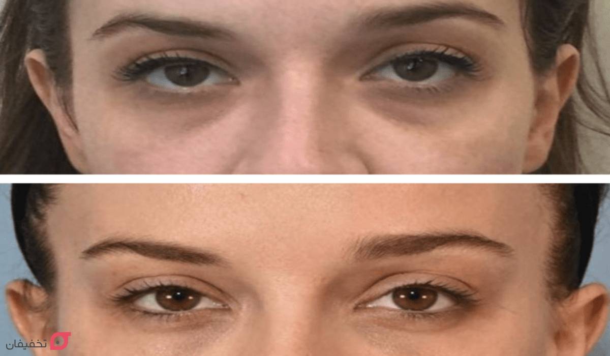 آیا فیلر زیر چشم باعث کوچک شدن چشم میشود؟ 2 آیا فیلر زیر چشم باعث کوچک شدن چشم میشود؟