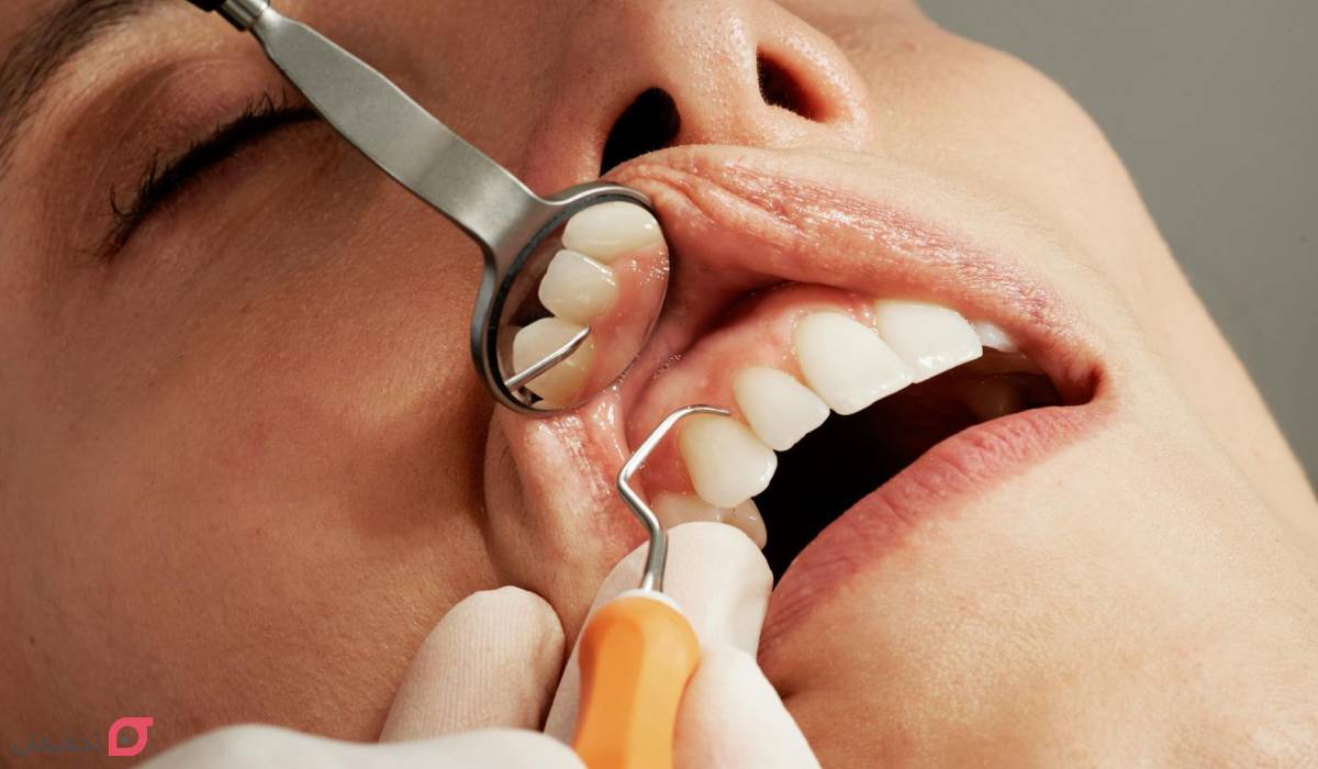آبسه دندان چیست؟ علائم و خطرات | درمان فوری و نحوه تخلیه 7 نحوه تخلیه آبسه دندان