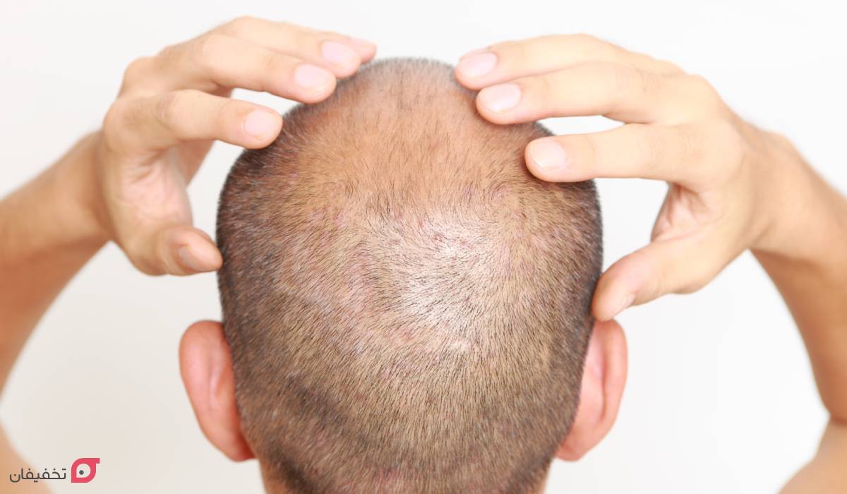 مراقبت های بعد از کاشت مو