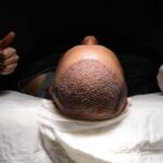 مراقبت بعد از کاشت مو | زمان استراحت، حمام و اولین شست و شو 20 مراقبت بعد از کاشت مو