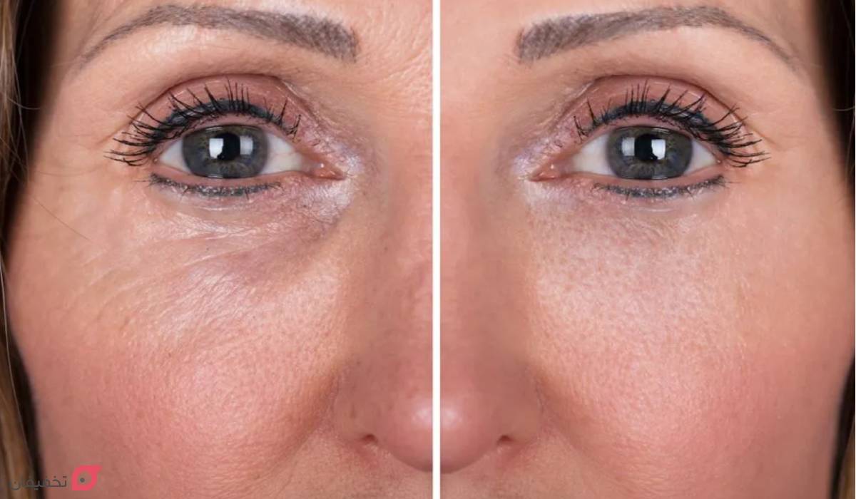 فیلر زیر چشم چند روز بعد اثر می کند؟