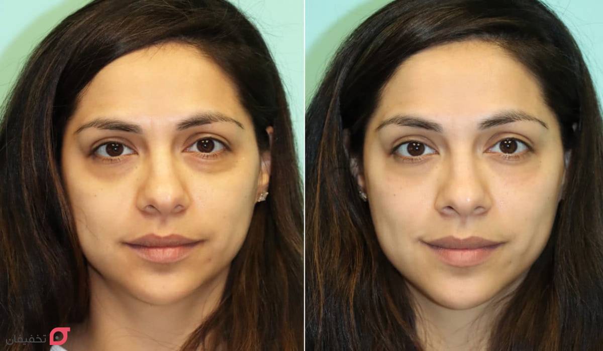 آیا فیلر زیر چشم باعث کوچک شدن چشم میشود؟ 3 ایا فیلر زیر چشم باعث کوچک شدن چشم میشود؟