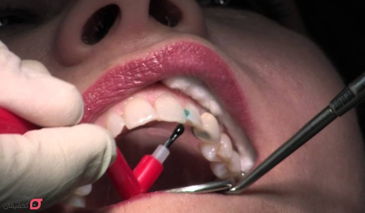 بهترین کامپوزیت دندان برای کدام کشور است | آلمان یا ژاپن؟ 3 بهترین کامپوزیت دندان برای کدام کشور است؟