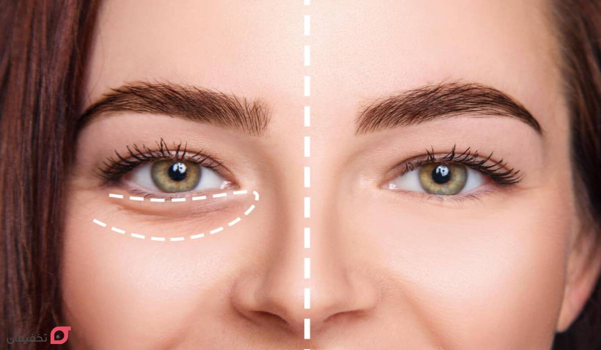 فیلر زیر چشم چند روز بعد اثر می کند؟