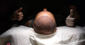 مراقبت بعد از کاشت مو