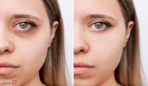 آیا فیلر زیر چشم باعث کوچک شدن چشم میشود؟