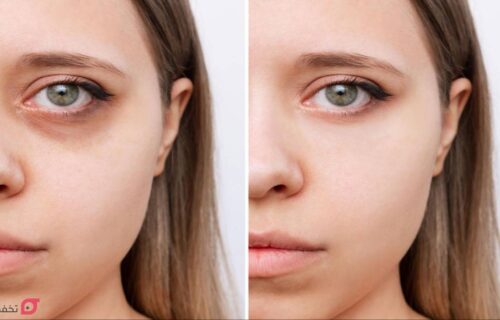 ایا فیلر زیر چشم باعث کوچک شدن چشم میشود؟