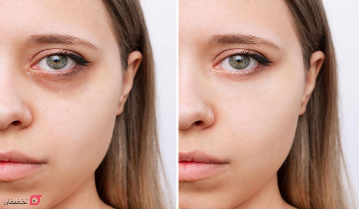 ایا فیلر زیر چشم باعث کوچک شدن چشم میشود؟