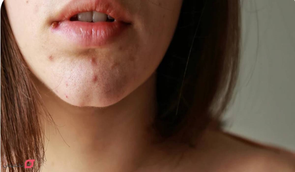 جوش چانه نشانه چیست | علت + 7 درمان شگفت انگیز در خانه 2 جوش چانه نشانه چیست؟