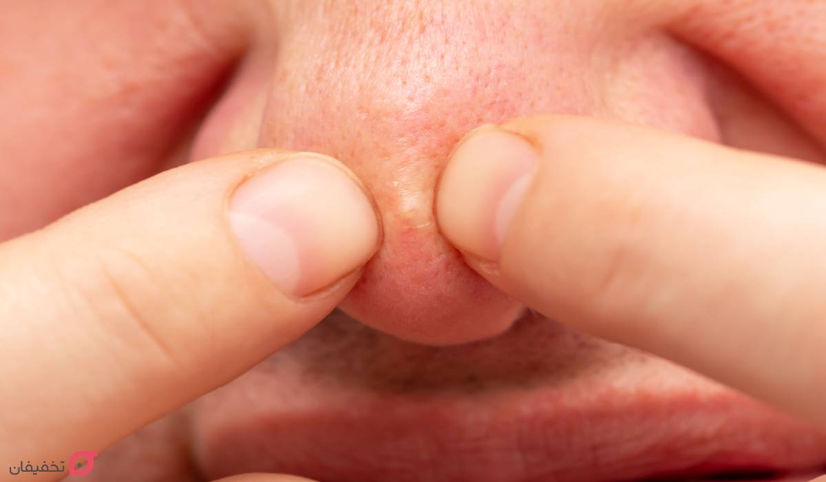 جوش روی بینی نشانه چیست | 8 درمان سریع و همیشگی در خانه 3 جوش روی بینی نشانه چیست؟