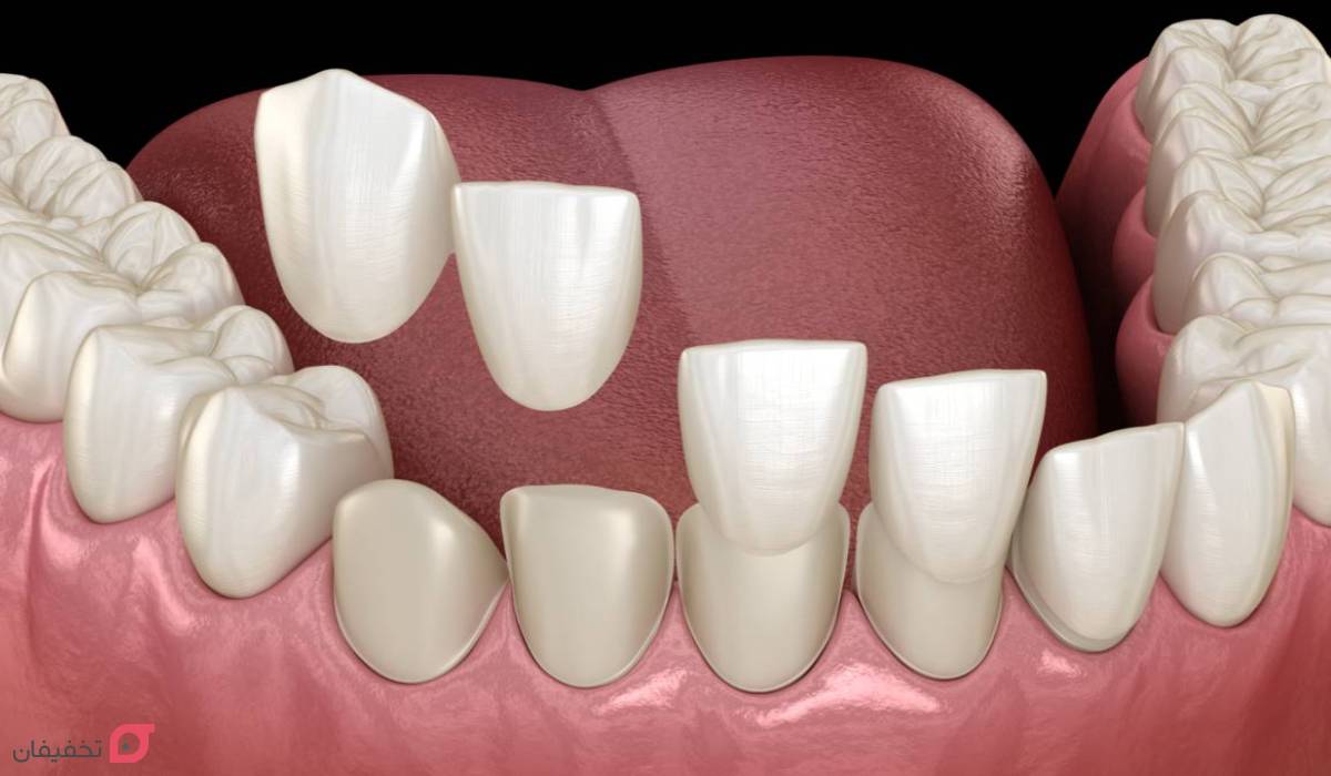 بهترین کامپوزیت دندان برای کدام کشور است | آلمان یا ژاپن؟ 5 کامپوزیت آلمانی یا سوئیسی