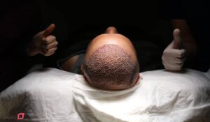 مراقبت بعد از کاشت مو | زمان استراحت، حمام و اولین شست و شو