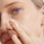 جوش روی بینی نشانه چیست | 8 درمان سریع و همیشگی در خانه 21 جوش روی بینی