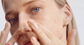 جوش روی بینی