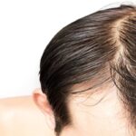 علت چرب شدن موی سر + 6 راه درمان قطعی و رفع دائمی چربی مو 26 علت چرب شدن موی سر