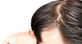 علت چرب شدن موی سر