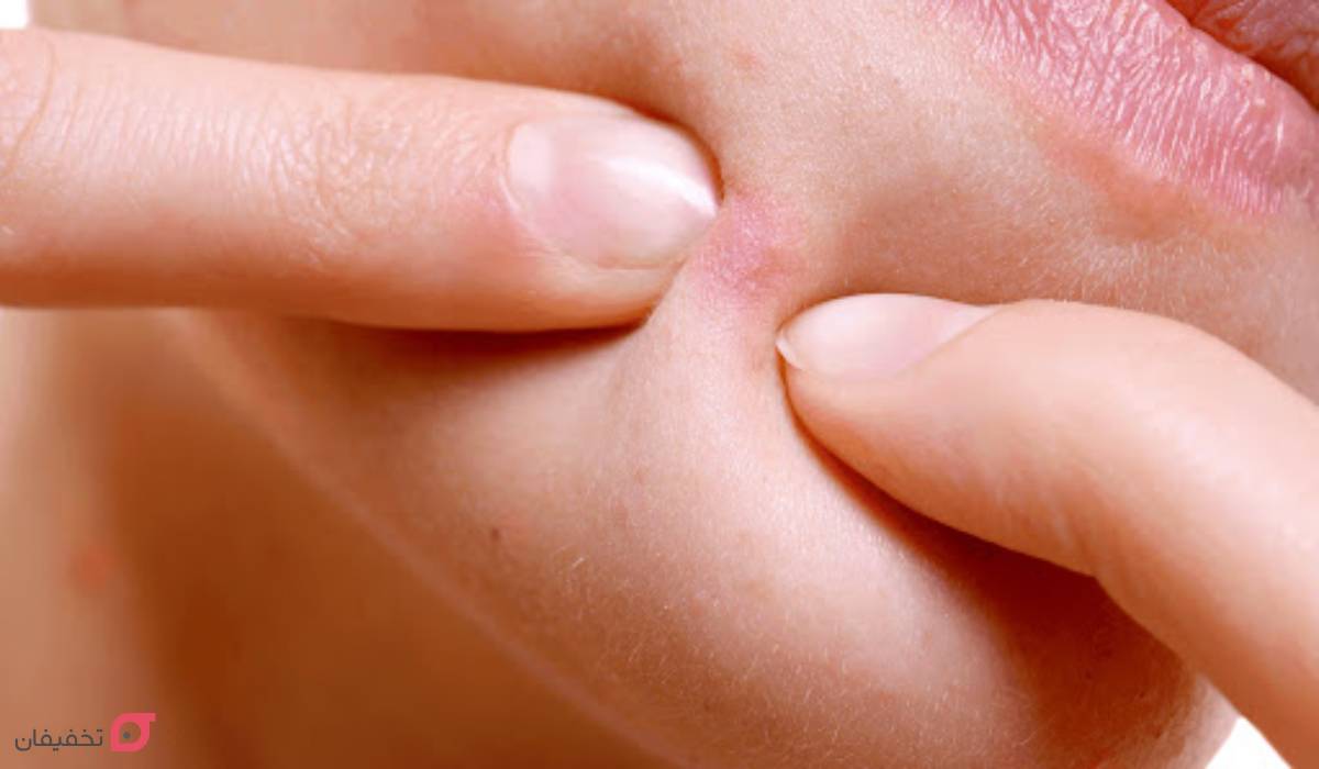 جوش چانه نشانه چیست | علت + 7 درمان شگفت انگیز در خانه 4 جوش چانه نشانه چیست؟