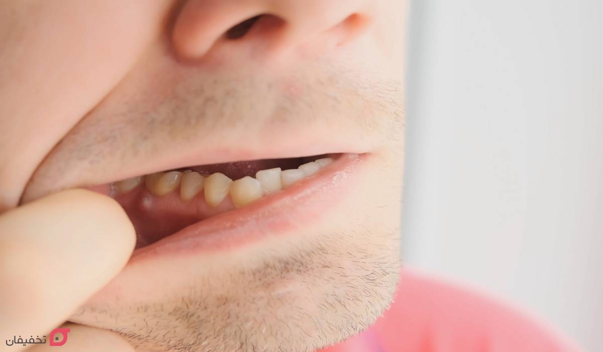 آبسه دندان چیست؟ علائم و خطرات | درمان فوری و نحوه تخلیه 3 انواع آبسه دندان و لثه