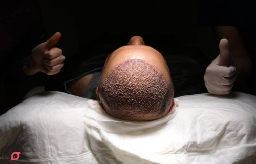 مراقبت بعد از کاشت مو