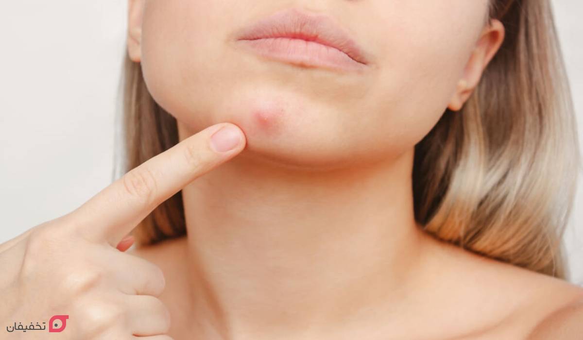 جوش چانه نشانه چیست | علت + 7 درمان شگفت انگیز در خانه 3 علت جوش چانه و فک