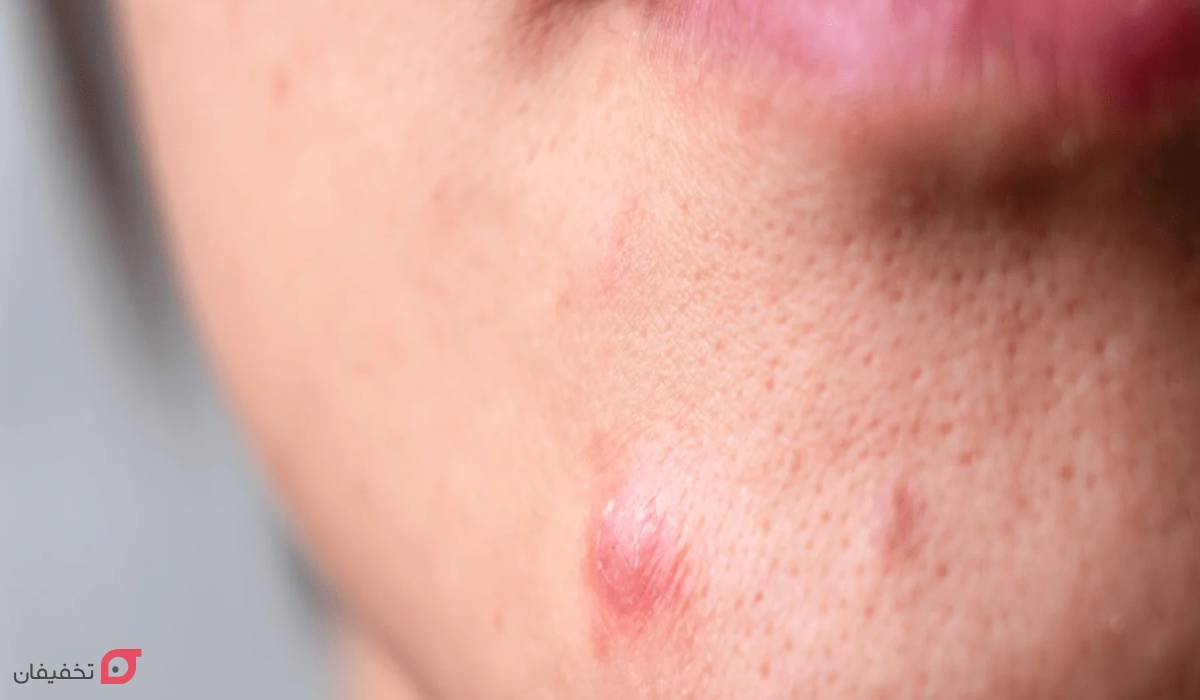 جوش چانه نشانه چیست | علت + 7 درمان شگفت انگیز در خانه 5 علت جوش چانه