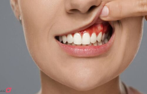 آبسه دندان چیست؟ علائم و خطرات | درمان فوری و نحوه تخلیه 24 آبسه دندان