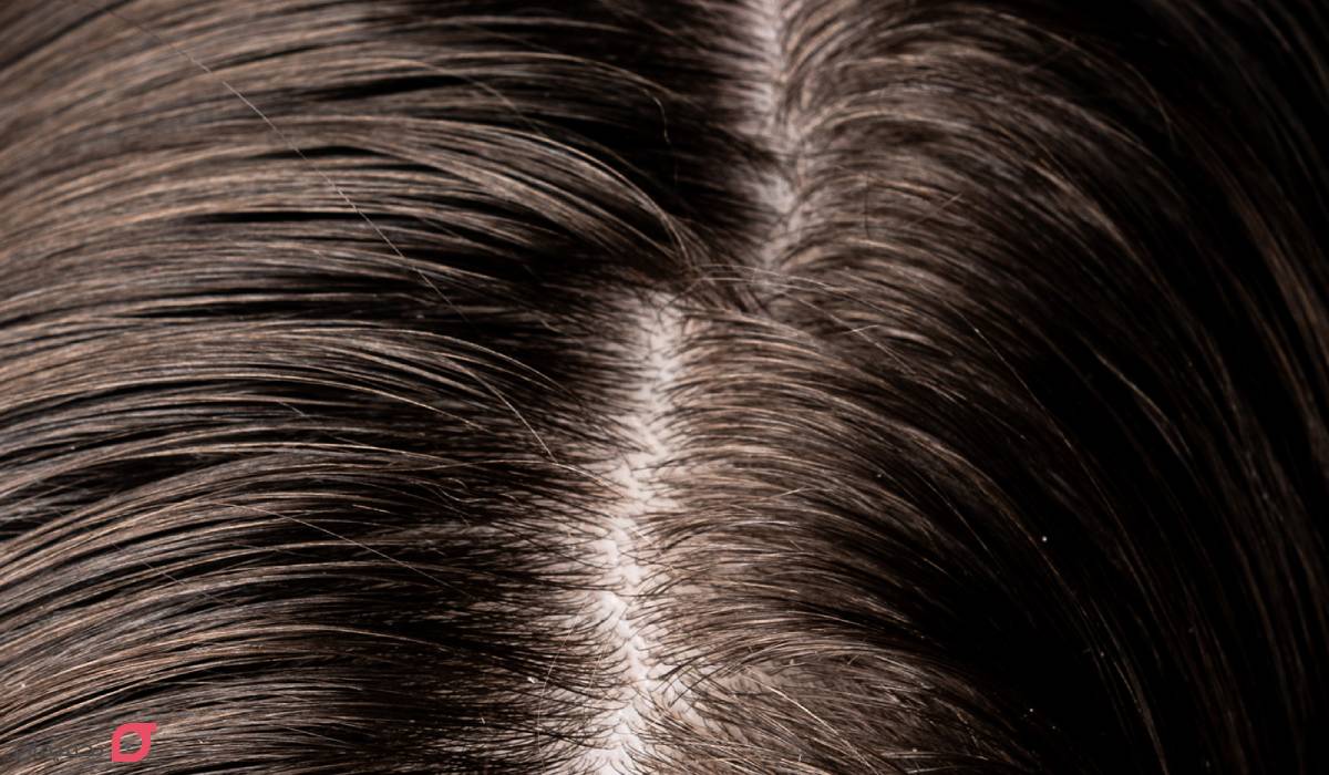 علت چرب شدن موی سر + 6 راه درمان قطعی و رفع دائمی چربی مو 2 موی چرب چه مویی است؟