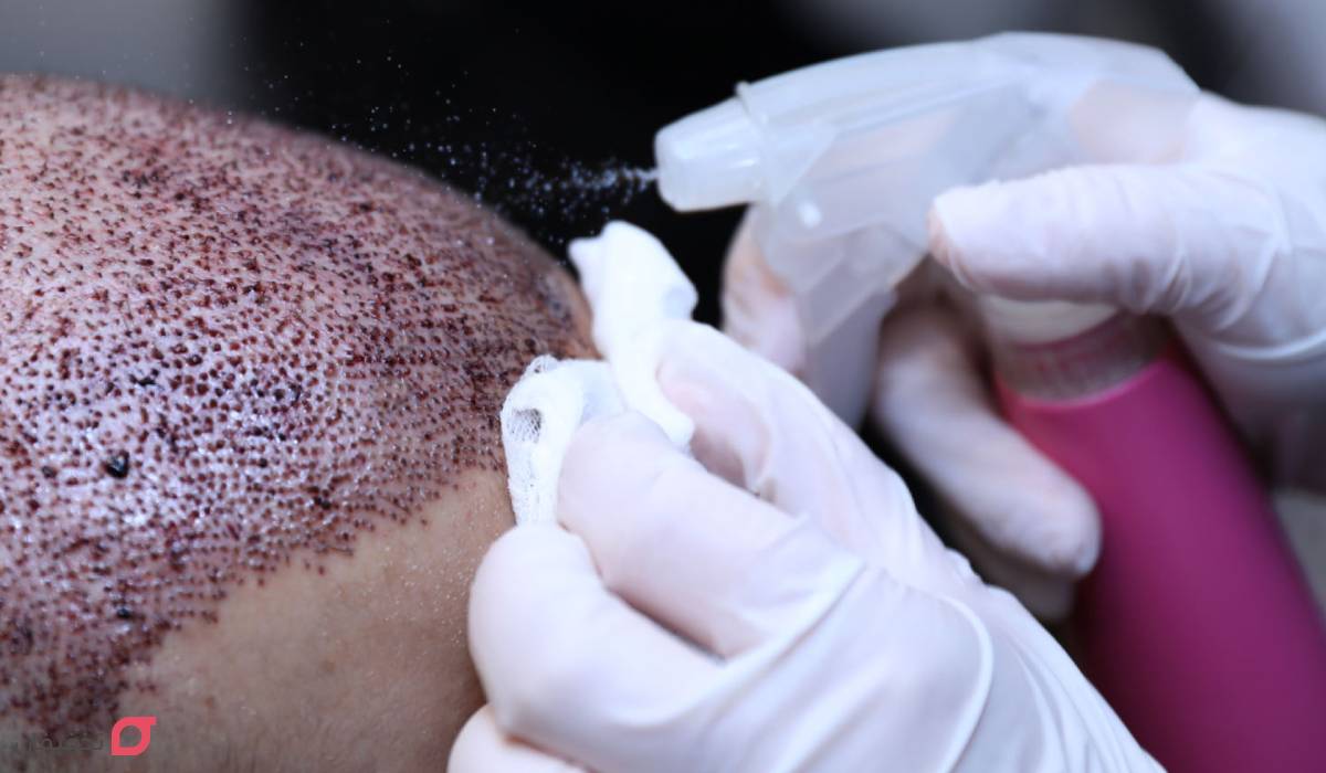 زمان حمام بعد از کاشت مو