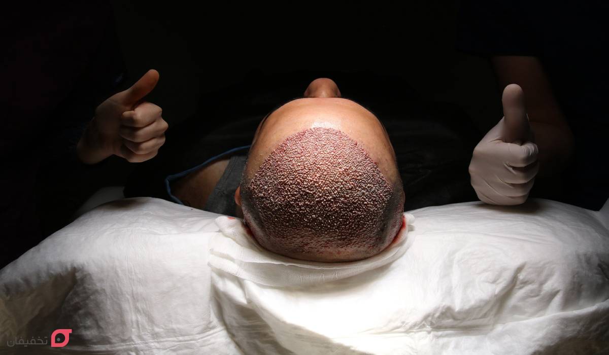 مراقبت بعد از کاشت مو