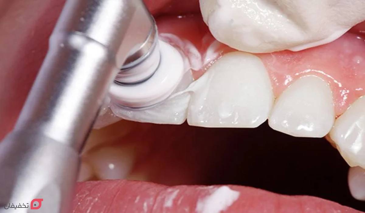 مراحل لمینت دندان با عکس | 11 مرحله با توضیح کامل و تصاویر 7 مراحل لمینت دندان با عکس