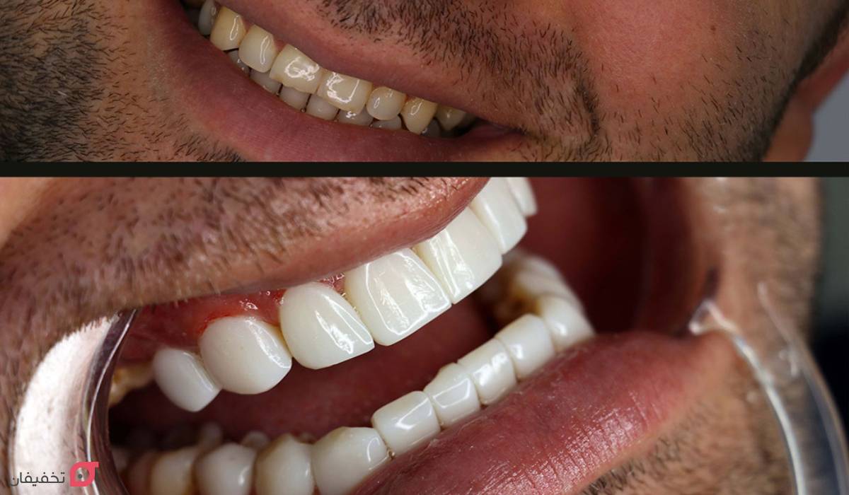 تفاوت لمینت و کامپوزیت و بلیچینگ | ماندگاری، هزینه و مزایا 4 تفاوت لمینت و کامپوزیت و بلیچینگ