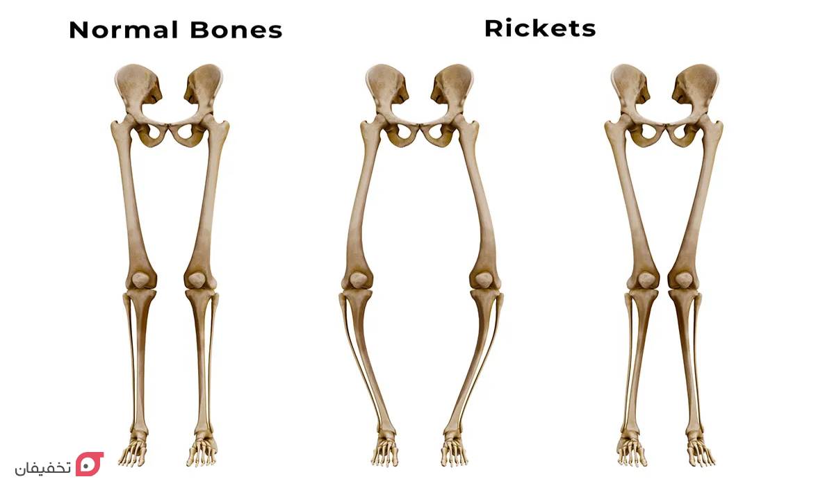 نرمی استخوان چیست | علت، علائم و درمان قطعی خانگی بزرگسالان 5 علائم نرمی استخوان