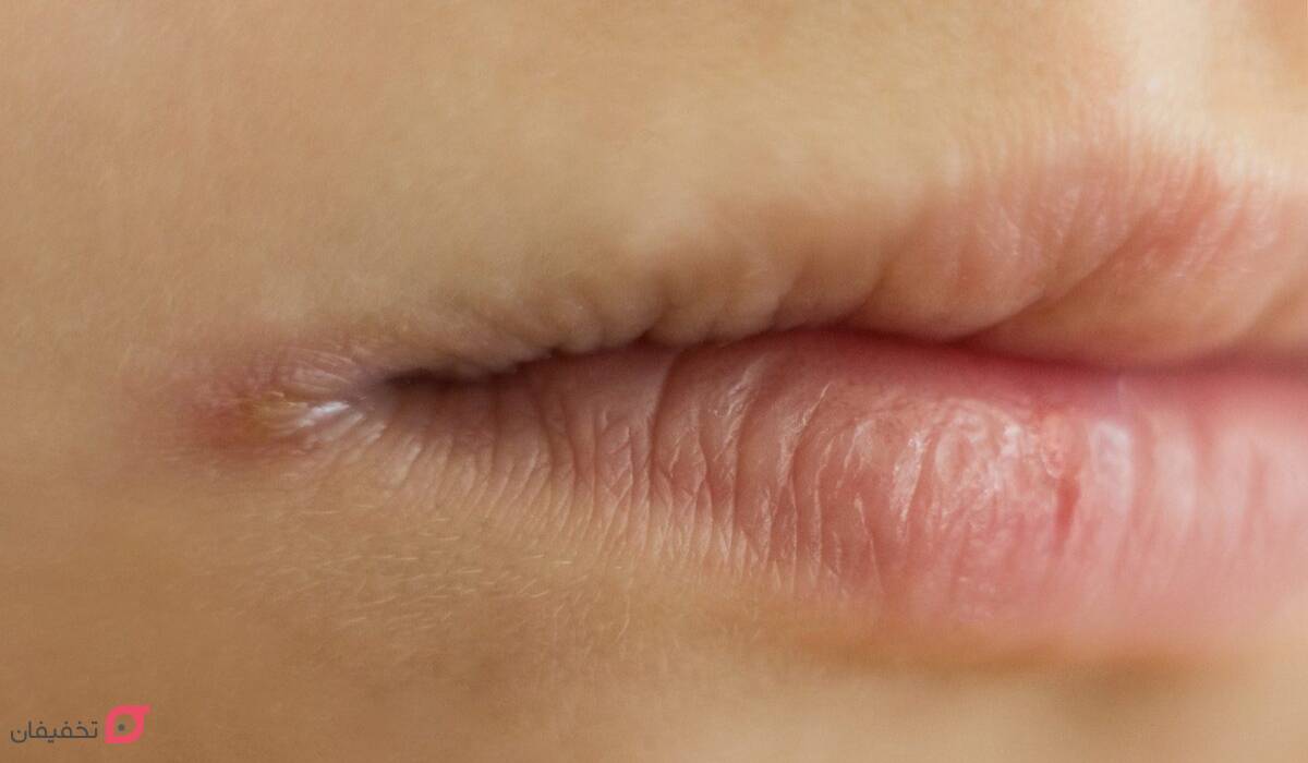 کمبود کدام ویتامین باعث ترک گوشه لب میشود؟ 5 علت ترک گوشه لب