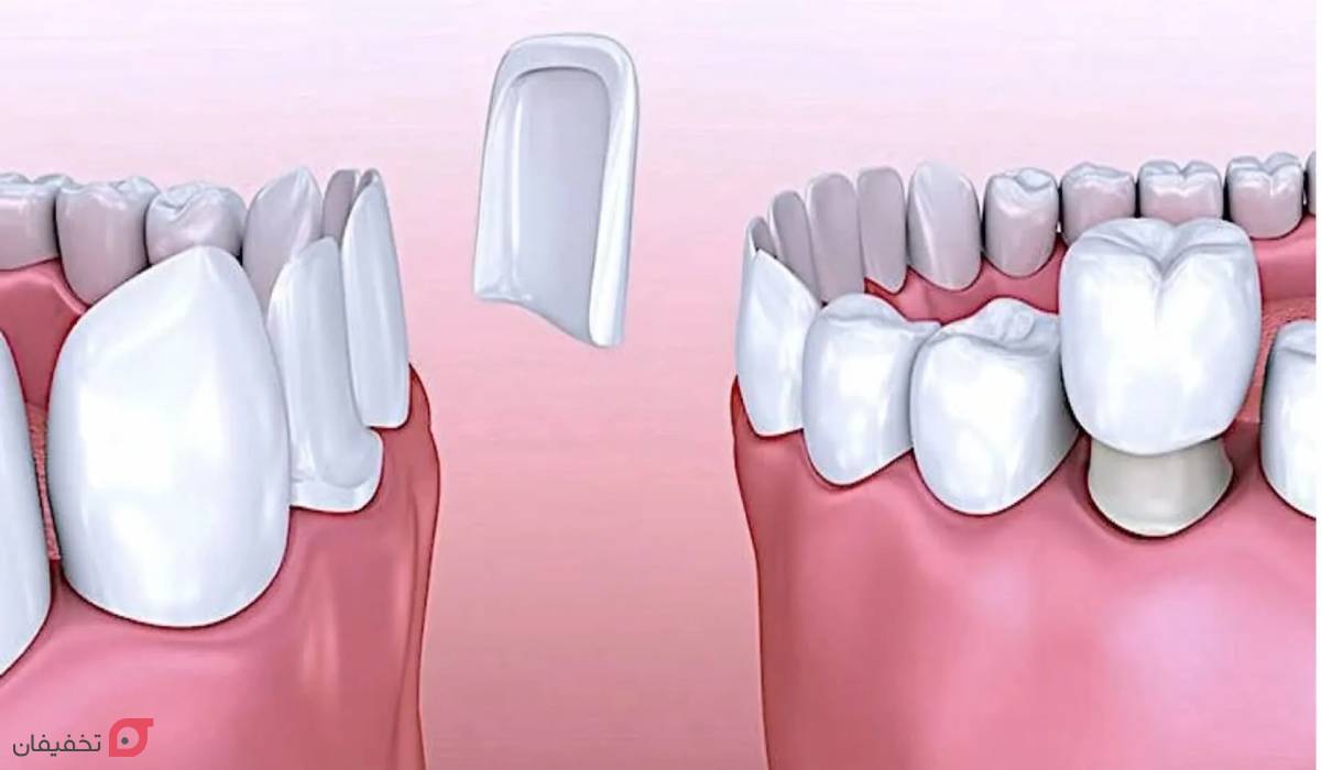 تفاوت لمینت و کامپوزیت و بلیچینگ | ماندگاری، هزینه و مزایا 8 تفاوت لمینت و کامپوزیت و بلیچینگ