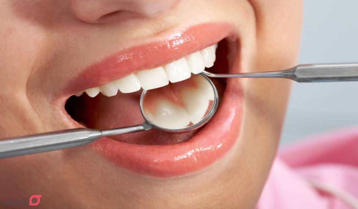 تفاوت لمینت و کامپوزیت و بلیچینگ | ماندگاری، هزینه و مزایا 3 تفاوت لمینت و کامپوزیت و بلیچینگ