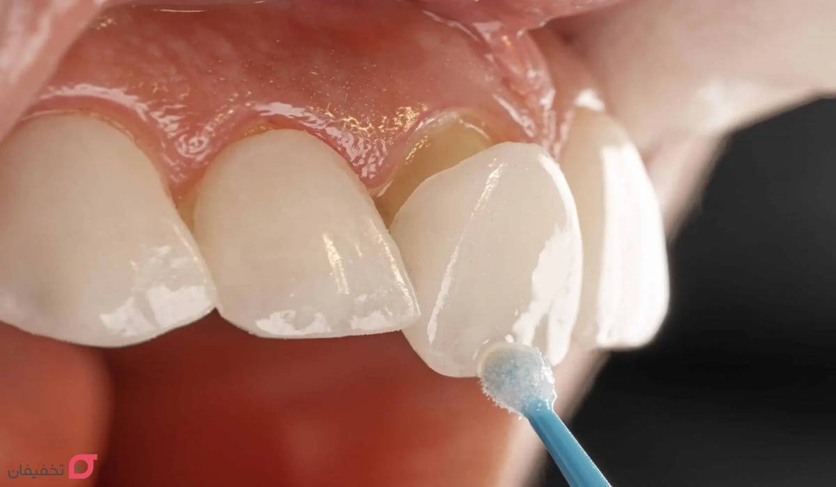 تفاوت لمینت و کامپوزیت و بلیچینگ | ماندگاری، هزینه و مزایا 5 تفاوت لمینت و کامپوزیت و بلیچینگ