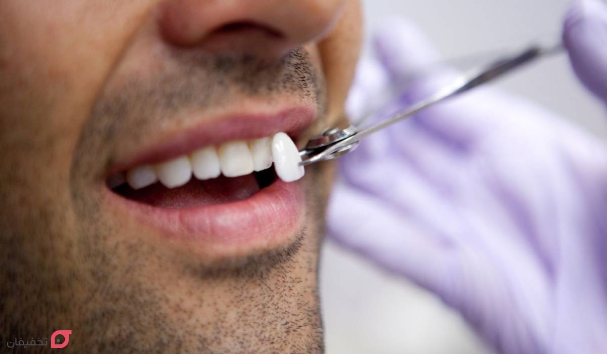 مراحل لمینت دندان با عکس | 11 مرحله با توضیح کامل و تصاویر 2 مراحل لمینت دندان