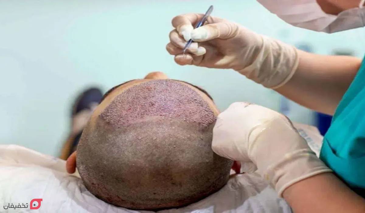 کاشت مو در شیراز بهتر است یا تهران | مقایسه هزینه و خدمات 6 کاشت مو در شیراز بهتر است یا تهران